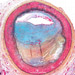 Allograft vasculopathy Movat
